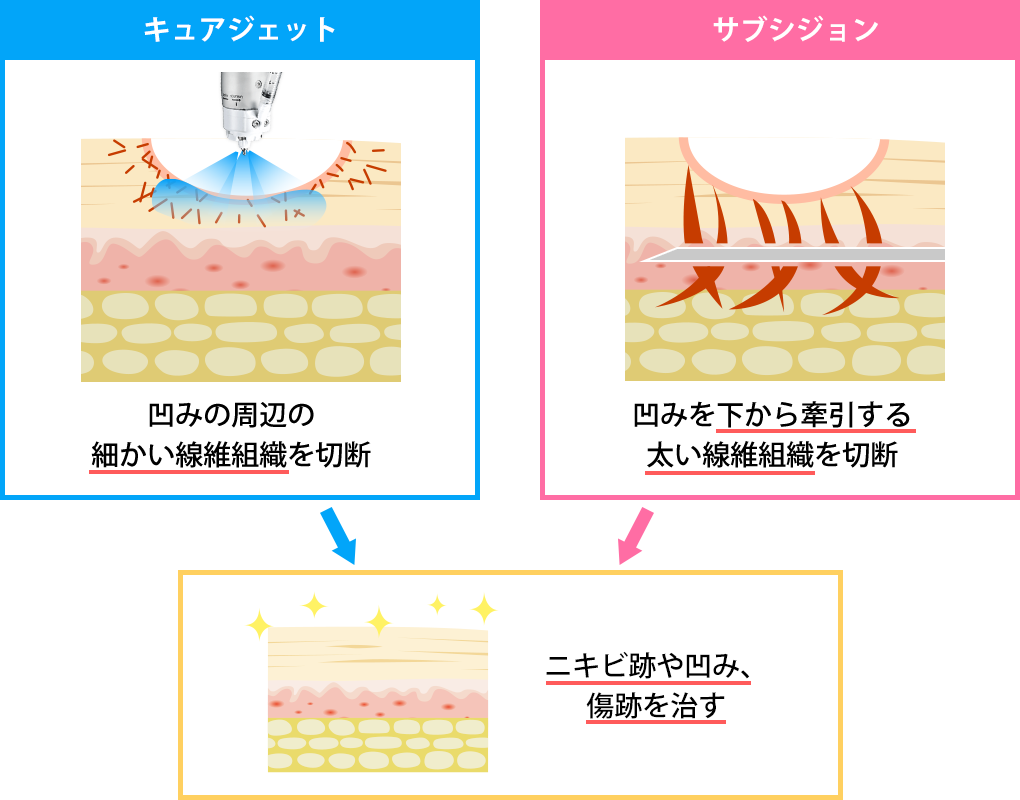 キュアジェットとサブシジョンの併用