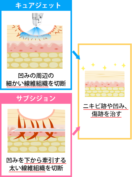 キュアジェットとサブシジョンの併用