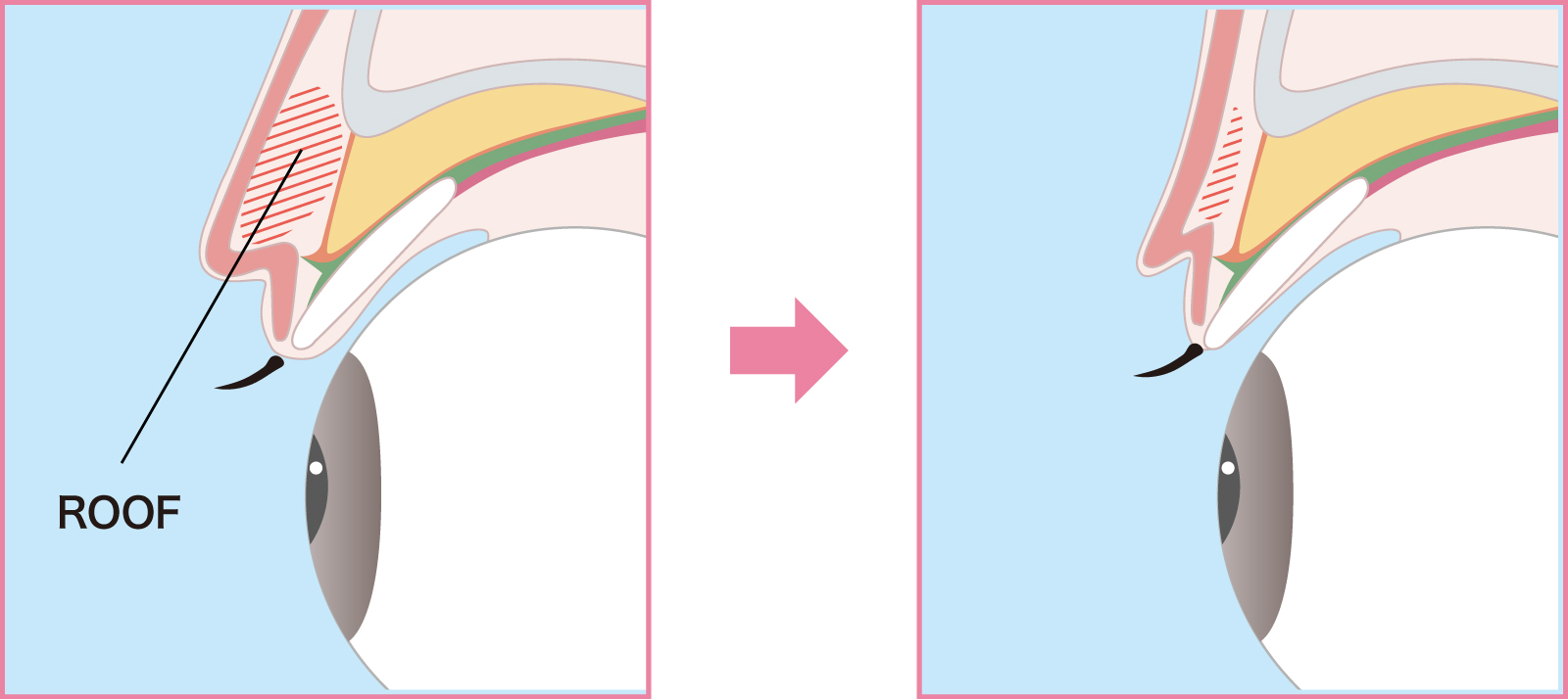切開のメカニズムイラスト