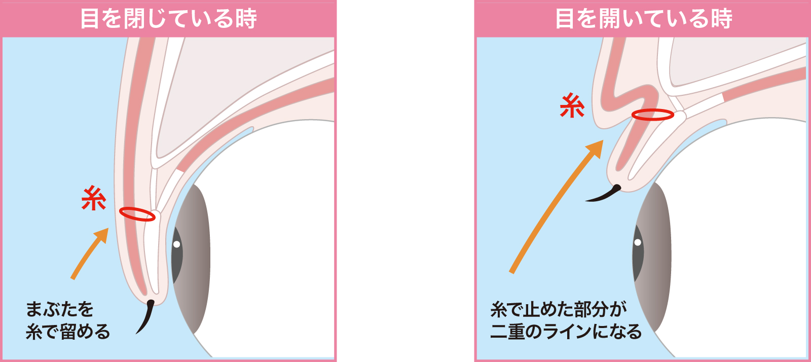 埋没メカニズムイラスト