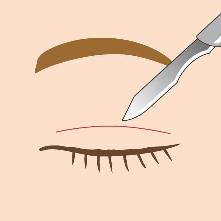 全切開イラスト