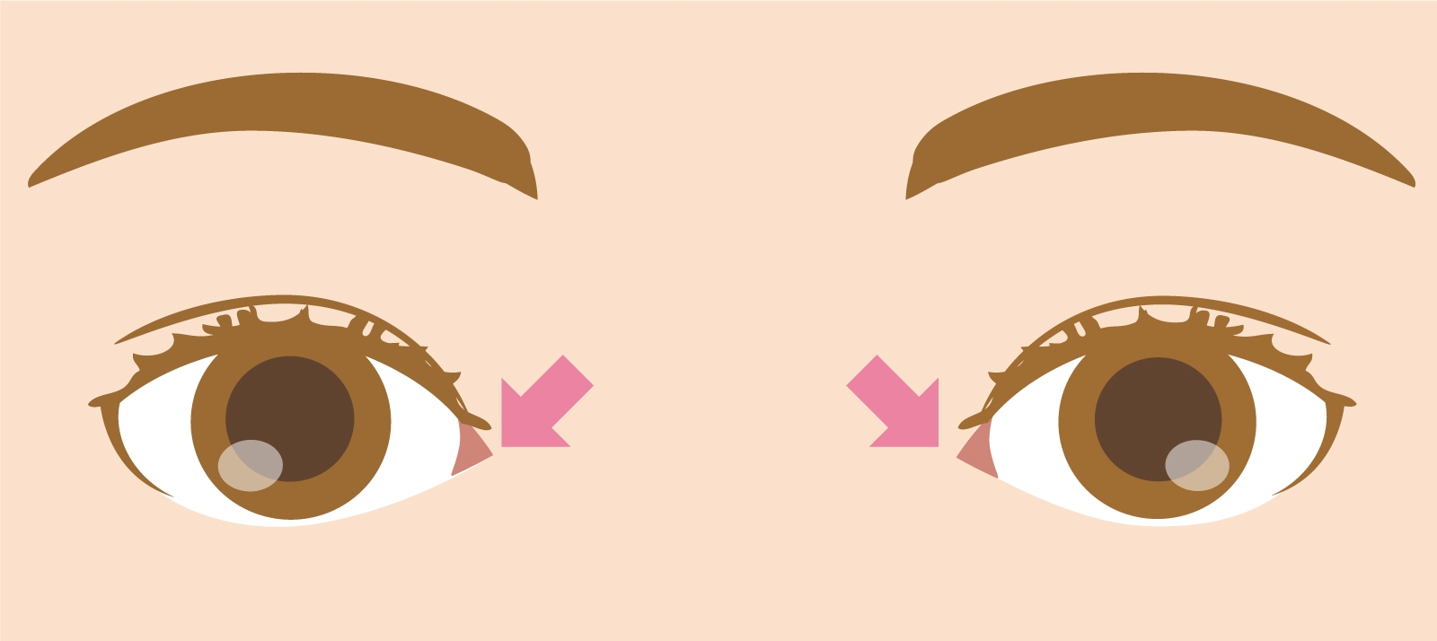 目頭切開イラスト