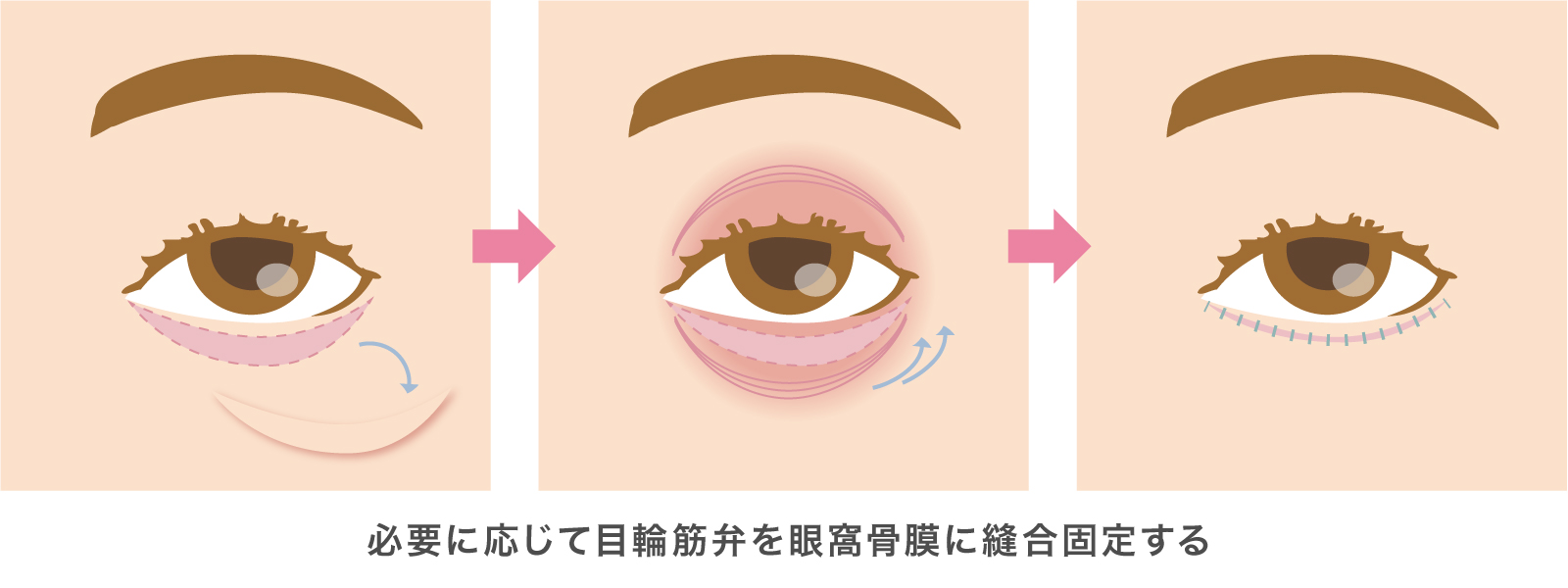 下眼瞼除皺術イラスト