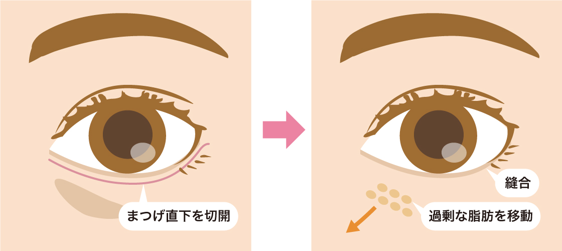 ハムラ法イラスト
