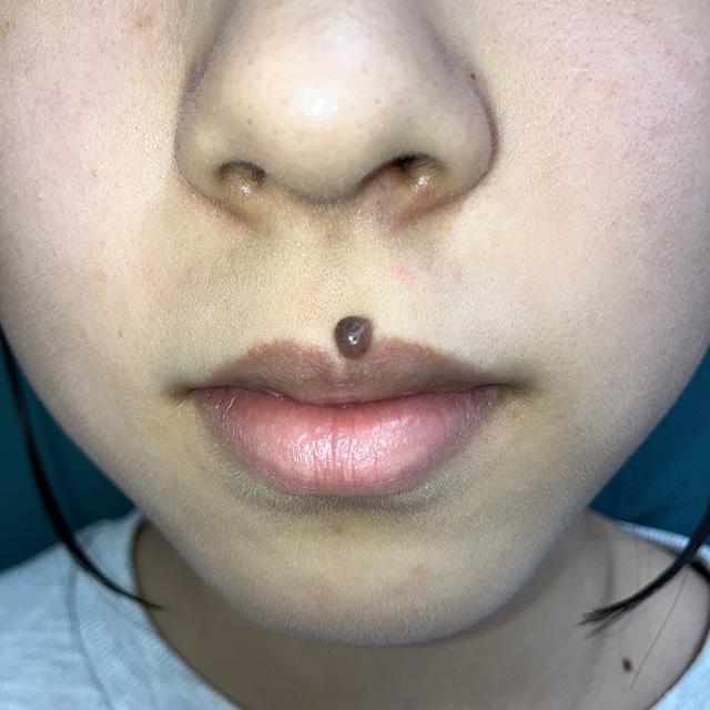 保険適用の手術