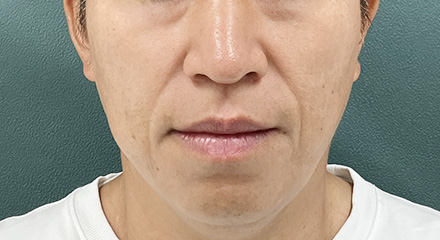 糸リフト症例画像 施術前