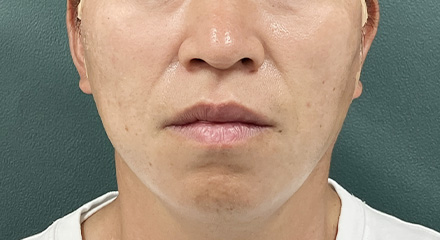 糸リフト症例画像 施術後
