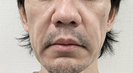 糸リフト症例画像 施術前