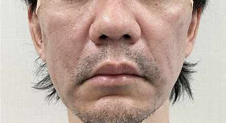 糸リフト症例画像 施術後