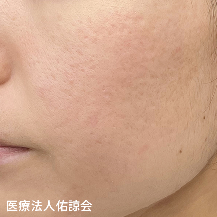 トライフィルプロ 施術後