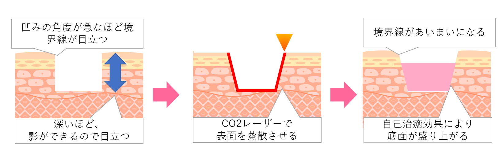 CO2アブレージョンのイラスト